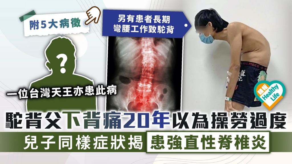 強直性脊椎炎｜駝背父下背痛20年以為操勞過度 兒子同樣症狀揭患強直性脊椎炎｜附5大常見病徵