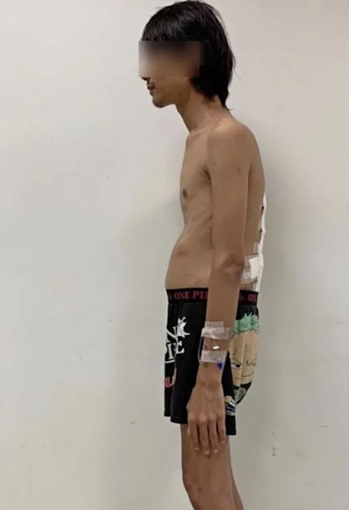 接受2次矯正手術後，才能重新抬頭挺胸做人。（網上圖片）