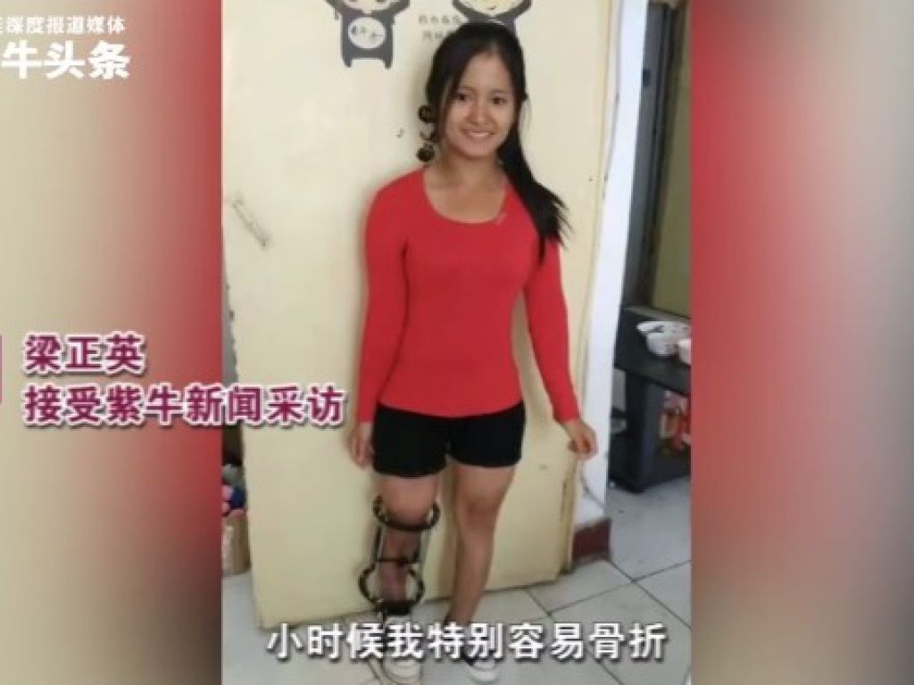 She said that she was particularly vulnerable to fractures when she was young.